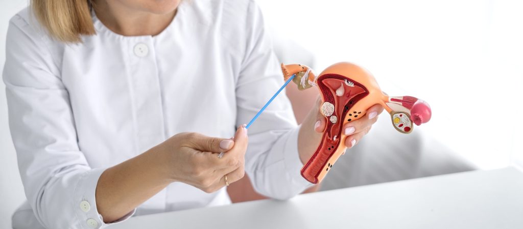 Illustration of a female reproductive system highlighting ovarian cysts